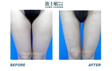 Liposuction-4