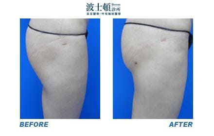 Liposuction