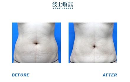 Liposuction-6