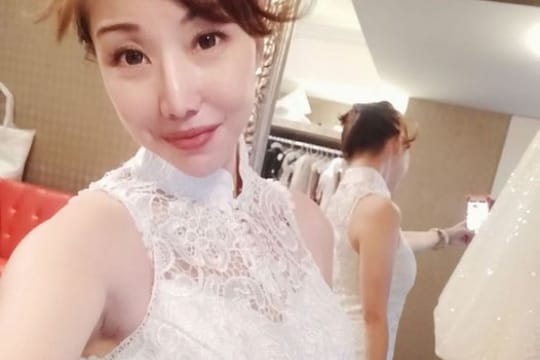池小V-兩頰拉提~埋線之王-藍鑽魚骨線-搶救嘴邊肉埋線紀錄